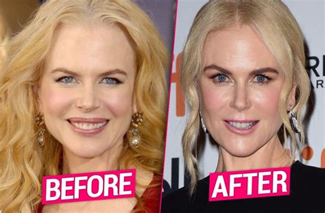 Nicole Kidman Plastic Surgery Before and After - Plastic SurgerYes