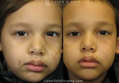 Laser Scar Removal Treatment New York, NY | Laser Center