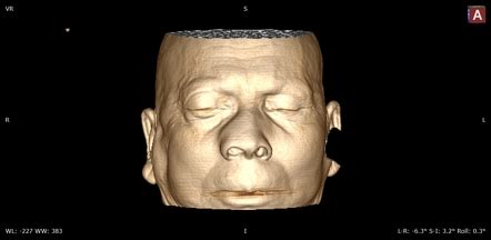 Rhinoscleroma | Image | Radiopaedia.org