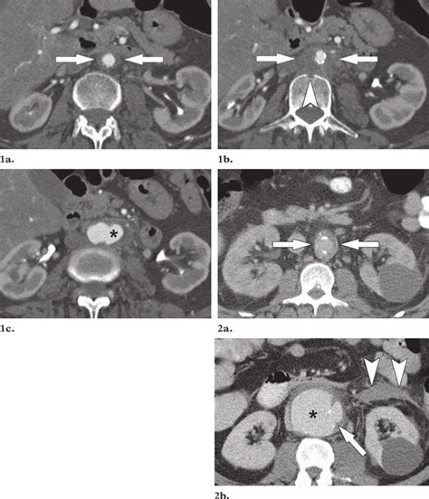 , 2. (1) Infected aneurysm of the infrarenal aorta in a 63-year-old... | Download Scientific Diagram