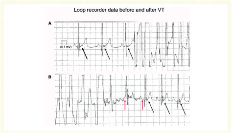 (A) Presence of Epsilon wave after EGM before the onset of VT (B ...