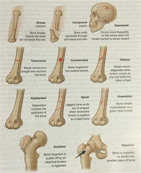 online lpn programs #schoolnursesalary | Types of fractures, Orthopedic nursing, Pediatric nursing