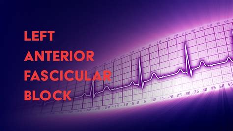 Left Anterior Fascicular Block - How to Read an Electrocardiogram (EKG ...