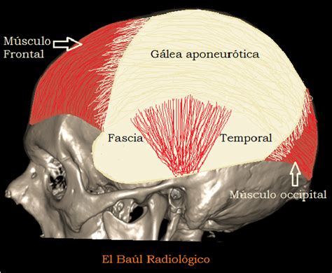 El Baúl Radiológico: 2) HEMATOMA SUBGALEAL: HALLAZGOS EN TOMOGRAFÍA COMPUTARIZADA e IRM ...