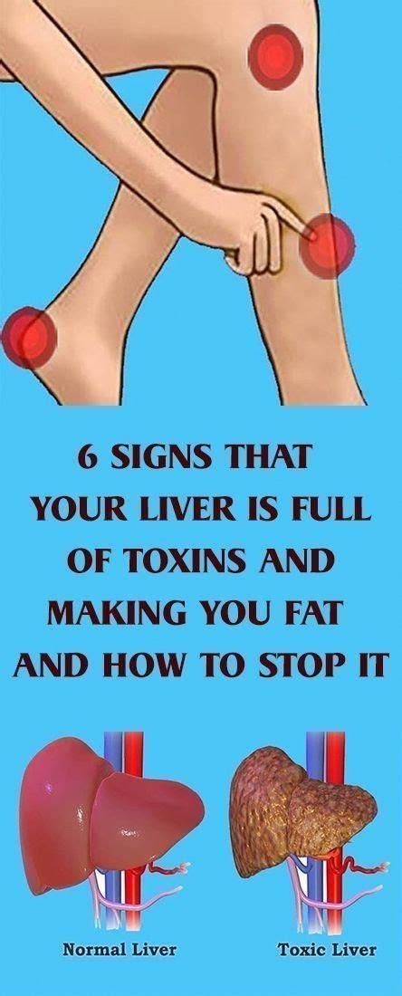 6 Signs That Your Liver Is Full Of Toxins in 2020 | Liver detox, Liver problems, Fatty liver disease