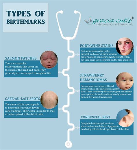 Types of Birthmarks | Laser clinics, Birthmark, Port wine stain