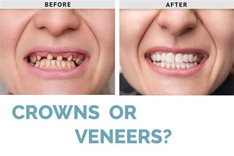 Difference Between Crown And Veneer | Renew Physical Therapy