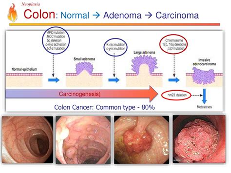 PPT - Pathology Lecture - Neoplasia PowerPoint Presentation, free ...