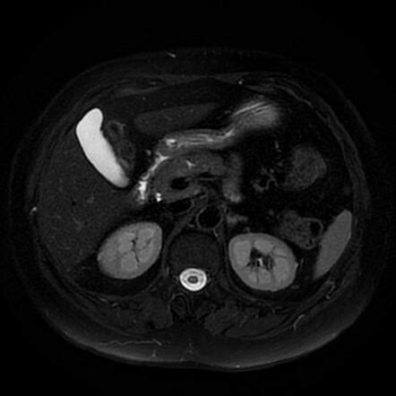 Insulinoma | Image | Radiopaedia.org