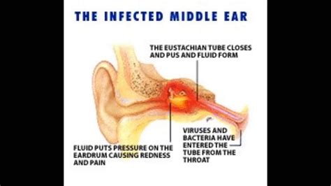 Conductive Hearing Loss Example - YouTube