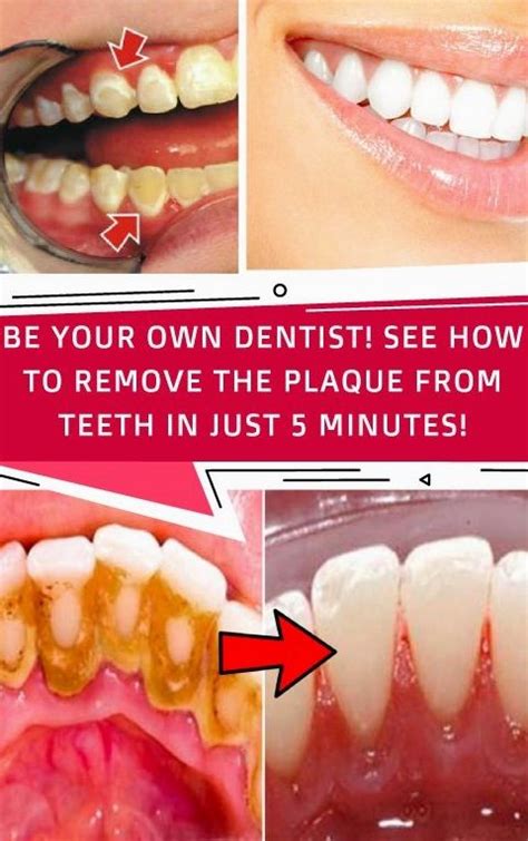 Be Your Own Dentist! See How To Remove The Plaque From Teeth In Just 5 ...