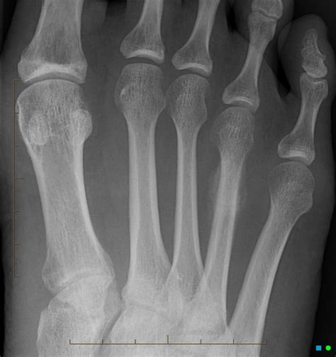 Metatarsal Bone Stress Fracture