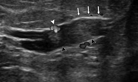 Asymmetric Ductal Ectasia: An Often Overlooked Sign of Malignancy | AJR