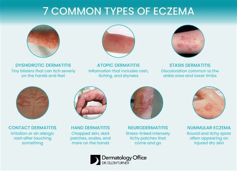 Eczema treatment in the Dallas area | Dr. Ellen Turner