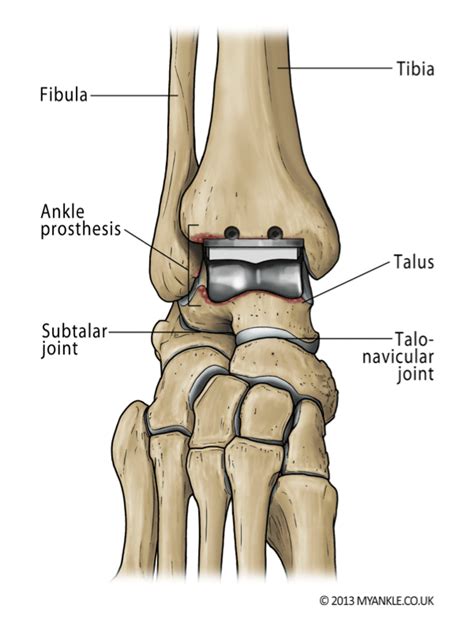 Ankle Replacement — Ankle Arthritis | Ankle Replacement | Arthrodesis | Ankle Fusion