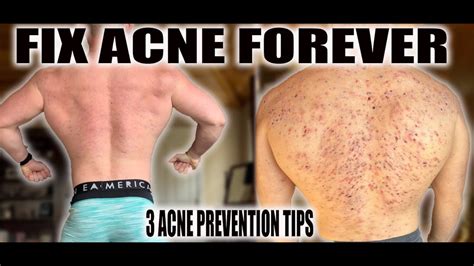 Extreme Steroid Acne | 3 Tips for perfect skin - YouTube