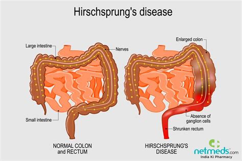 Hirschsprung Disease: Causes, Symptoms And Treatment | Netmeds