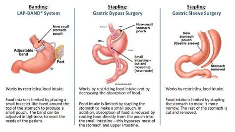 Comparing Lap Band with Gastric Sleeve and Gastric Bypass | Gastric ...