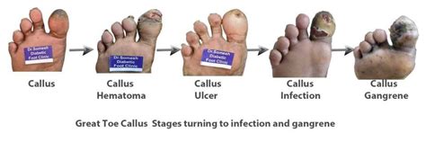 Diabetic Foot Gangrene stages Great Toe Tip - Podiatry Doctor