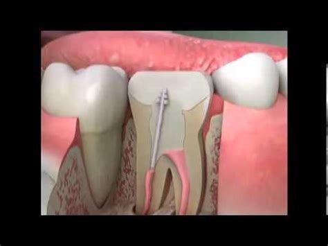 Crowns - procedure - Post and core - YouTube