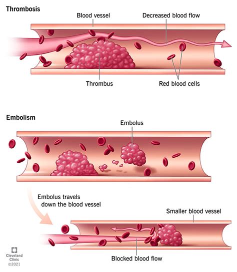 Thrombosis: Symptoms & Treatment