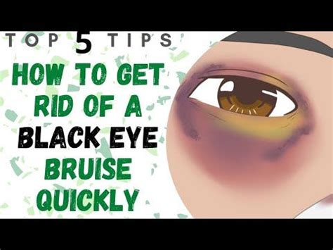 Black eye remedies – Artofit