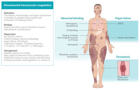 Disseminated Intravascular Coagulation Discounts Shop | dev-techtatva ...