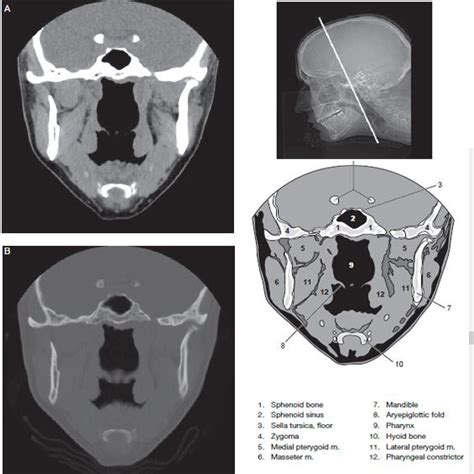 Sinus CT Scan - RadTechOnDuty