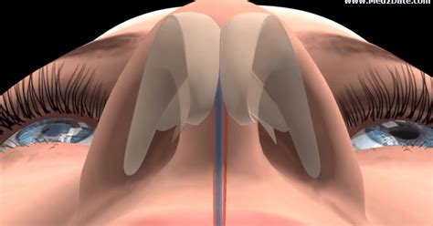 Deviated nasal septum causes, pathology, symptoms, treatment