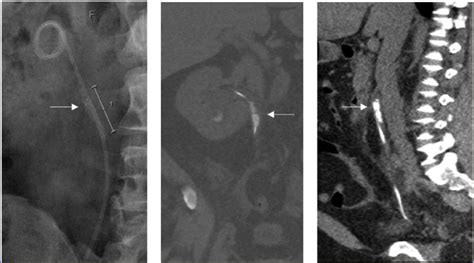 KUB radiograph and CT KUB imaging showing encrustations (indicated by ...