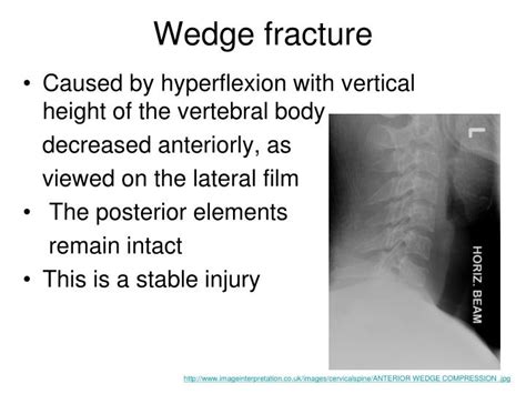 PPT - Cervical Spine Trauma PowerPoint Presentation - ID:2442688