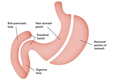 Mini Gastric Bypass vs Duodenal Switch - Mexico Bariatric Center