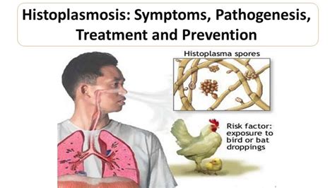 Introduction to Histoplasmosis - Microbiology Notes