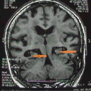 (PDF) Are Vascular Factors Linked to the Development of Hippocampal Atrophy in Alzheimer's Disease?