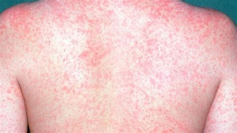 Officials: 30 measles cases in western Washington outbreak