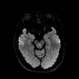 Radiology Cases: Decussation Of Superior Cerebellar Peduncle Fibres