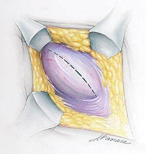 Modified Shouldice - Hernia Repair Technique - Hernia Center of Ohio