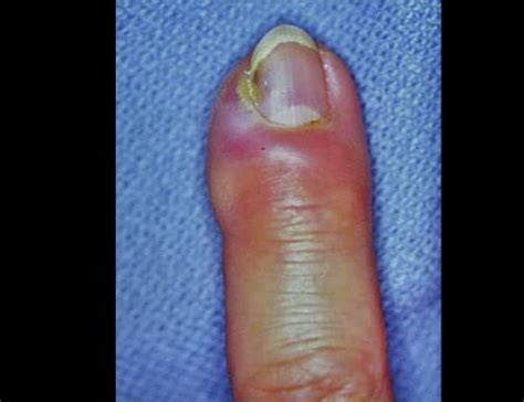 Acute Paronychia: The Dark Side of Nail-biting — BROWN EMERGENCY MEDICINE BLOG