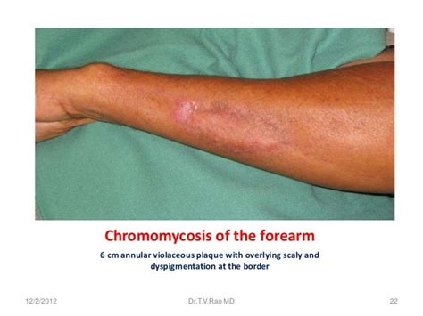 Deep fungal infections