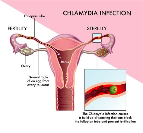 Can Chlamydia Cause Infertility? - Cherokee Women's Health