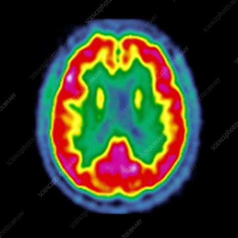 Normal brain activity, PET scan - Stock Image - C026/7612 - Science ...