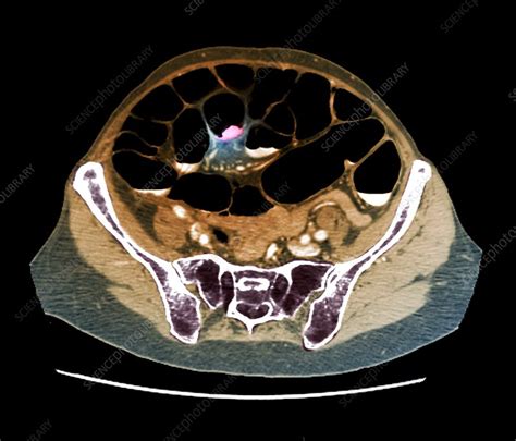 Colon cancer, CT scan - Stock Image - C047/9253 - Science Photo Library