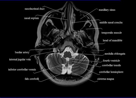 Axial Brain Anatomy