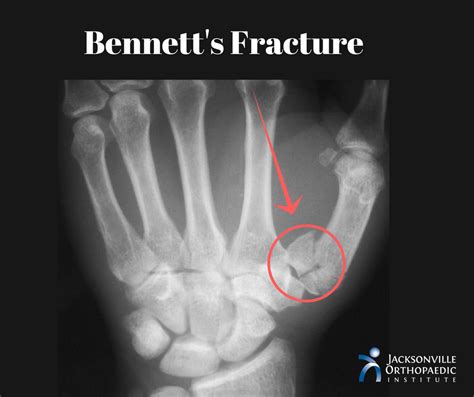 Bennett's Fracture: Break At The Base of Your Thumb