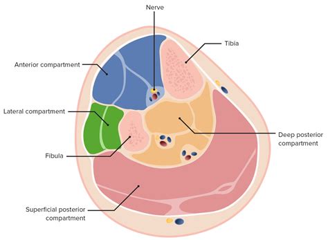 Compartment Syndrome | Concise Medical Knowledge