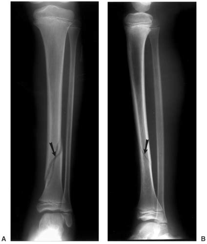 Tibial Fibular Fracture