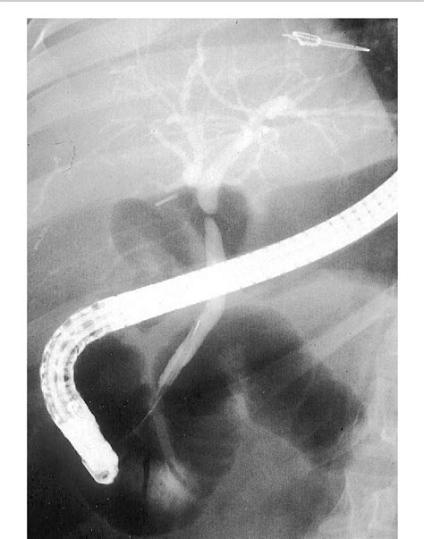 Figure 1 from An unusual cause of biliary stricture in a patient with ...