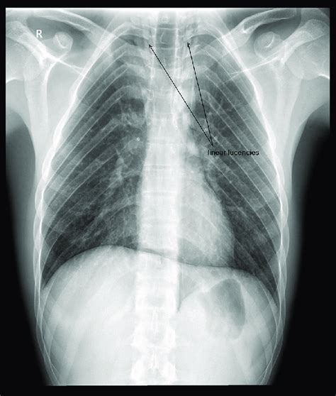 Posterior Anterior X Ray