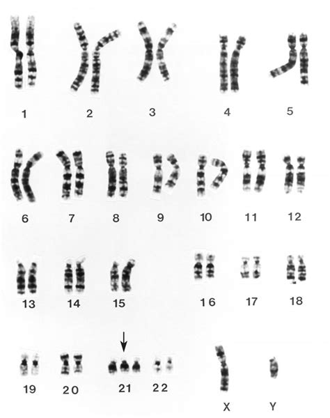 Image: Down-Syndrom-Karyotyp - MSD Manual Profi-Ausgabe