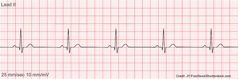 Sinus Bradycardia ECG/EKG NCLEX Quiz